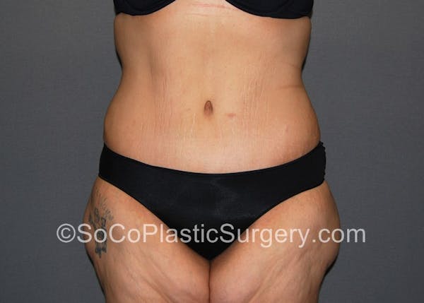 Tummy Tuck Before & After Gallery - Patient 5089235 - Image 2