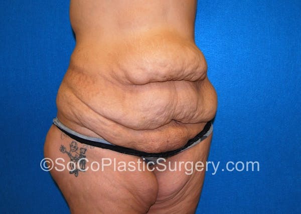 Tummy Tuck Before & After Gallery - Patient 5089235 - Image 3