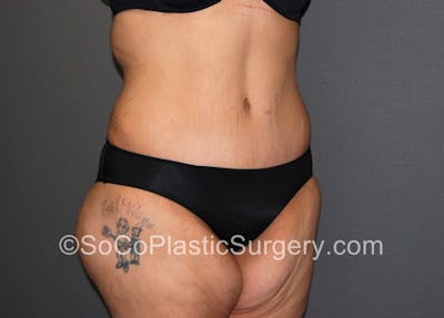 Tummy Tuck Before & After Gallery - Patient 5089235 - Image 4