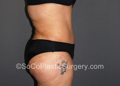 Tummy Tuck Gallery - Patient 5089235 - Image 6