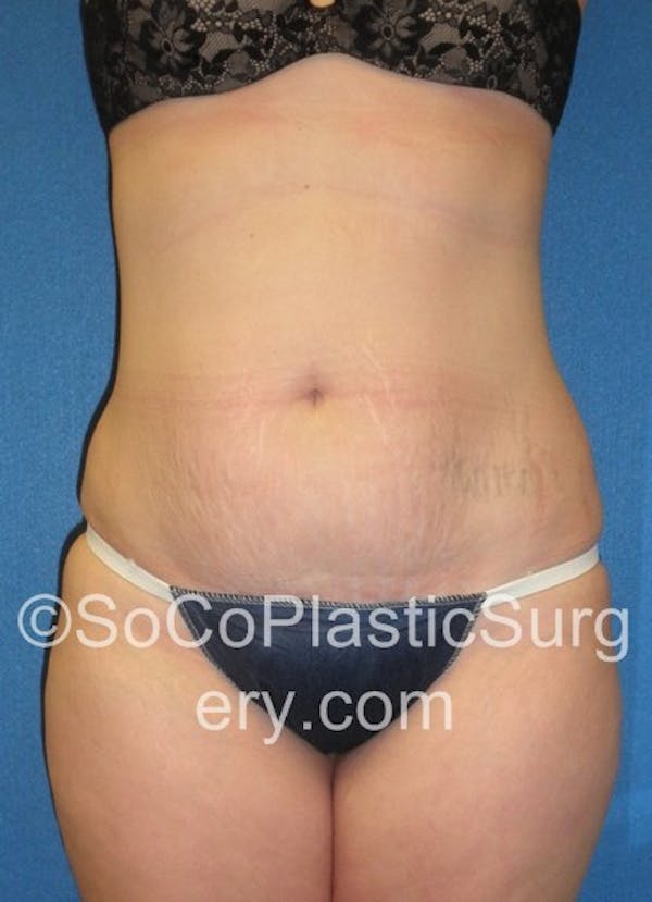 Tummy Tuck Gallery - Patient 5089318 - Image 1