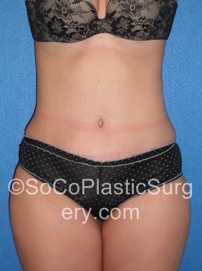 Tummy Tuck Before & After Gallery - Patient 5089318 - Image 2