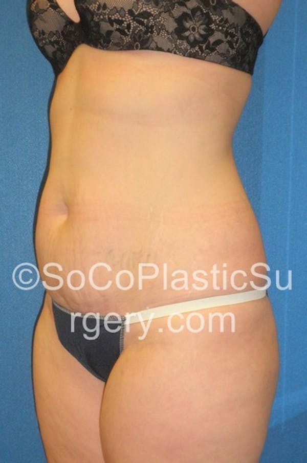 Tummy Tuck Before & After Gallery - Patient 5089318 - Image 3