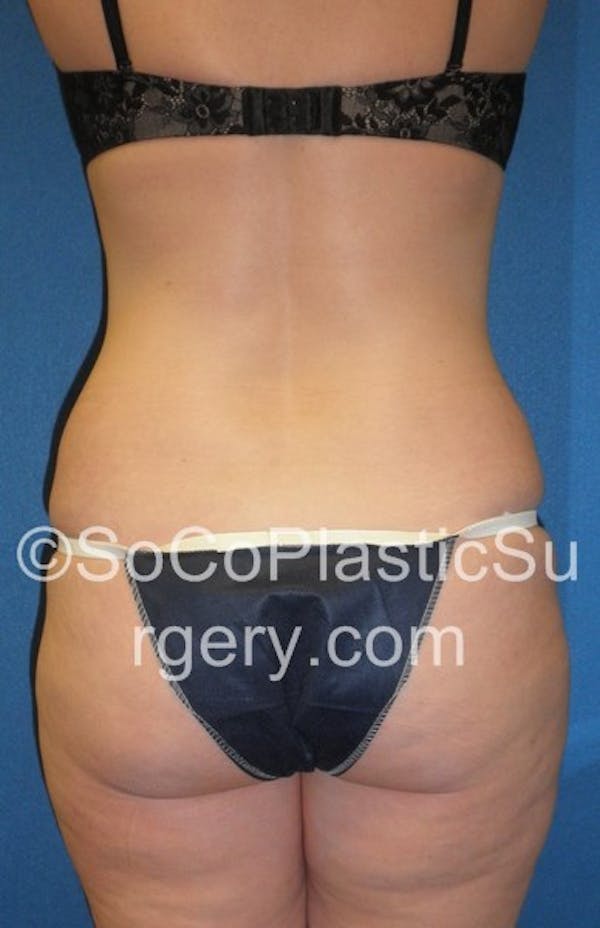 Tummy Tuck Gallery - Patient 5089318 - Image 5