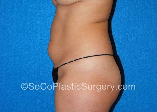 Tummy Tuck Gallery - Patient 5089485 - Image 5