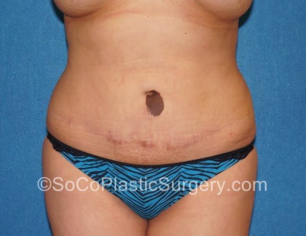 Tummy Tuck Gallery - Patient 5089546 - Image 1