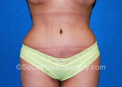 Tummy Tuck Before & After Gallery - Patient 5089546 - Image 2
