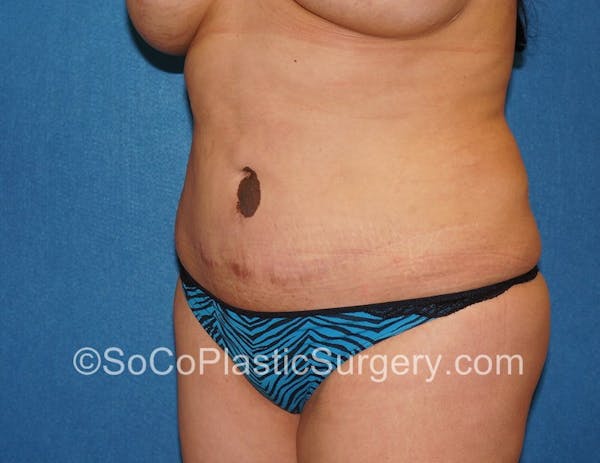 Tummy Tuck Before & After Gallery - Patient 5089546 - Image 3