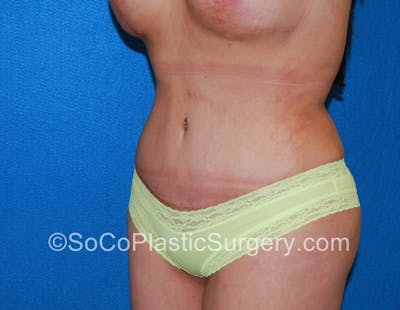 Tummy Tuck Before & After Gallery - Patient 5089546 - Image 4
