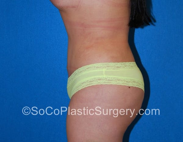 Tummy Tuck Before & After Gallery - Patient 5089546 - Image 6