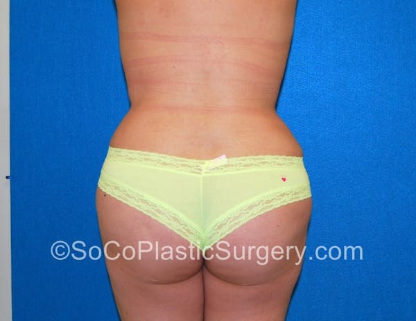 Tummy Tuck Before & After Gallery - Patient 5089546 - Image 8