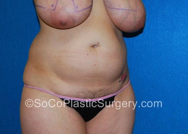 Tummy Tuck Before & After Gallery - Patient 5089578 - Image 3
