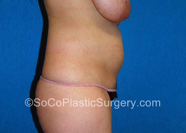 Tummy Tuck Gallery - Patient 5089578 - Image 5