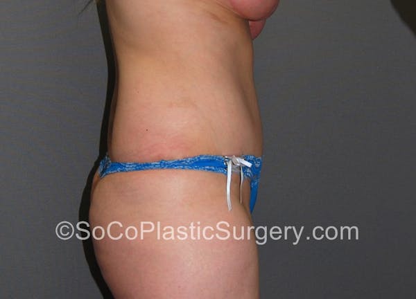Tummy Tuck Before & After Gallery - Patient 5089578 - Image 6