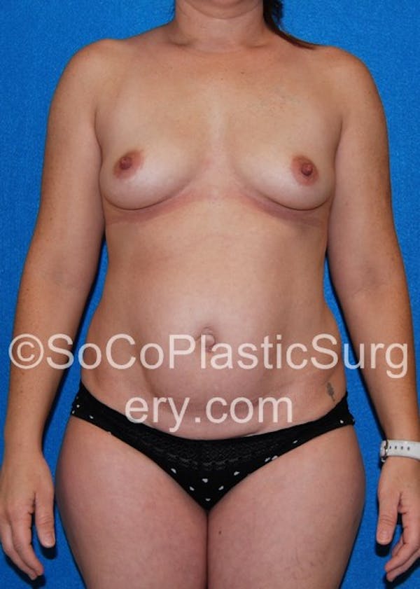 Mommy Makeover Before & After Gallery - Patient 5089715 - Image 5