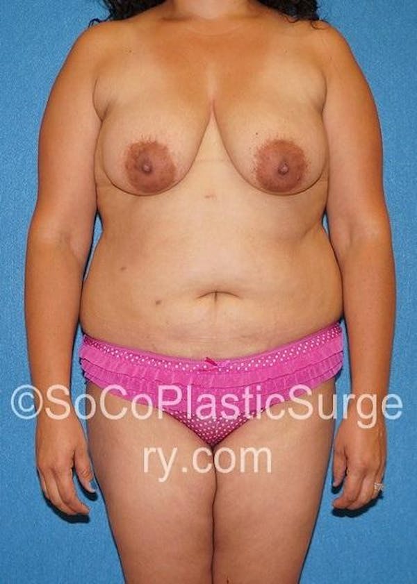 Mommy Makeover Gallery - Patient 5090136 - Image 1