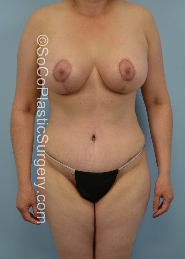 Mommy Makeover Before & After Gallery - Patient 5090187 - Image 2