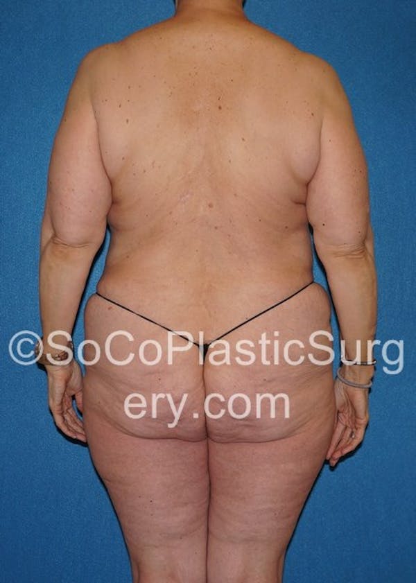 Mommy Makeover Before & After Gallery - Patient 5090263 - Image 7