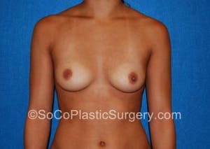 Close up Before and After of Breast Augmentation in Orange County