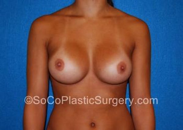 Close up Before and After of Breast Augmentation in Orange County