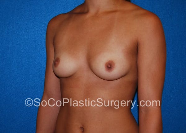 Breast Augmentation Before & After Gallery - Patient 5090380 - Image 5