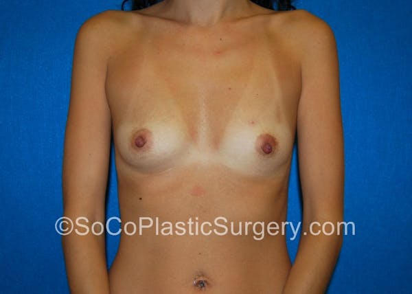 Breast Augmentation Before & After Gallery - Patient 5090486 - Image 1