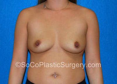 Breast Augmentation Before & After Gallery - Patient 5090640 - Image 1