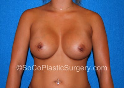 Breast Augmentation Before & After Gallery - Patient 5090640 - Image 2