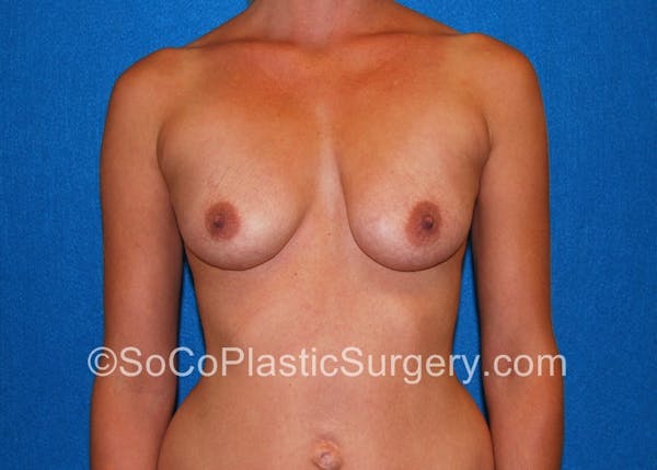 Breast Augmentation Before & After Gallery - Patient 5090711 - Image 1