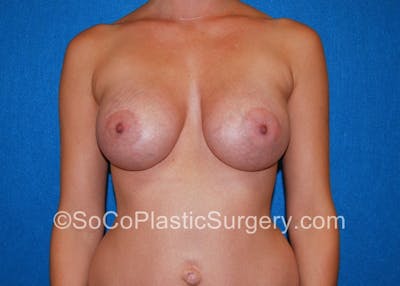 Breast Augmentation Before & After Gallery - Patient 5090711 - Image 2