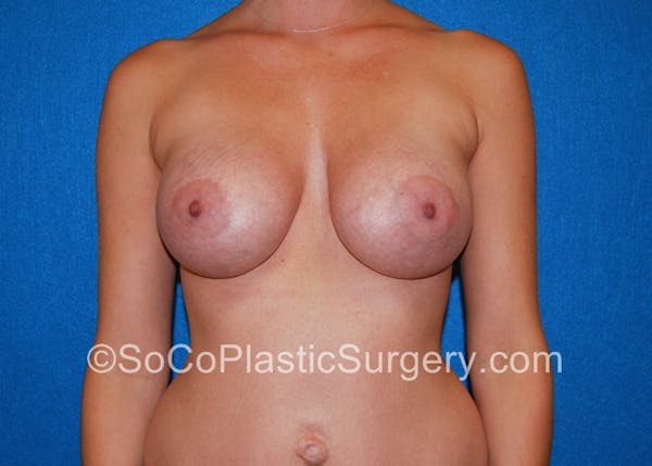 Breast Augmentation Before & After Gallery - Patient 5090711 - Image 2