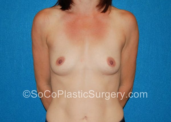 Breast Augmentation Before & After Gallery - Patient 5090771 - Image 1