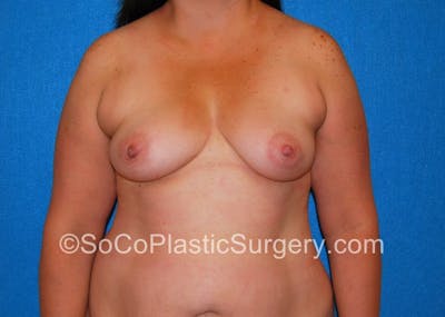 Breast Augmentation Before & After Gallery - Patient 5090859 - Image 1