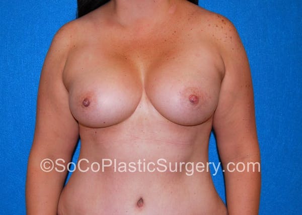 Breast Augmentation Before & After Gallery - Patient 5090859 - Image 2
