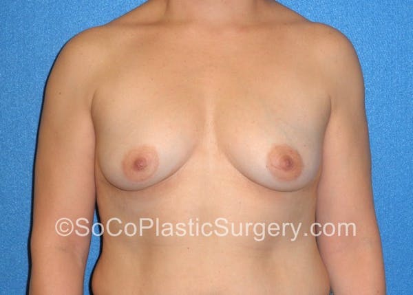Breast Augmentation Before & After Gallery - Patient 5090988 - Image 1