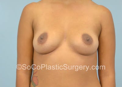 Breast Augmentation Before & After Gallery - Patient 5091061 - Image 1