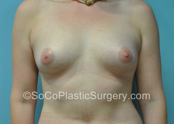 Breast Fat Transfer Before & After Gallery - Patient 5091200 - Image 2