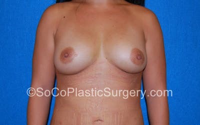 Breast Fat Transfer Before & After Gallery - Patient 5091251 - Image 2