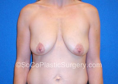 Breast Lift Gallery - Patient 5091280 - Image 1