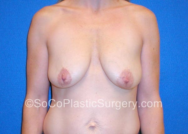 Breast Lift Before & After Gallery - Patient 5091280 - Image 1