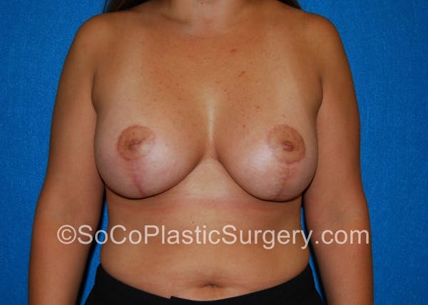 Breast Lift Gallery - Patient 5091373 - Image 2