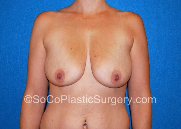 Breast Lift Before & After Gallery - Patient 5091459 - Image 1