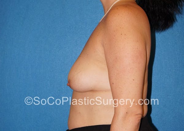 Breast Lift Before & After Gallery - Patient 5091555 - Image 5