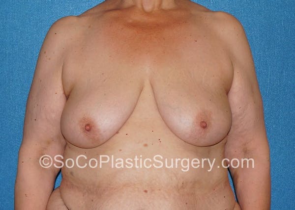 Breast Lift Gallery - Patient 5091696 - Image 1