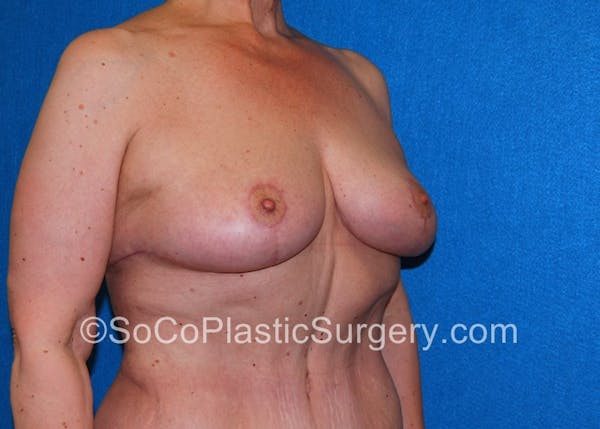 Breast Lift Before & After Gallery - Patient 5091696 - Image 4