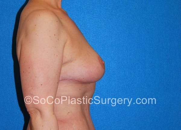 Breast Lift Gallery - Patient 5091696 - Image 6