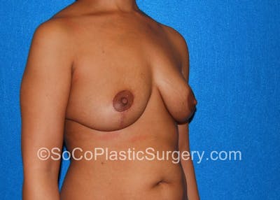 Breast Lift Before & After Gallery - Patient 5091764 - Image 4