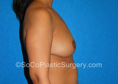 Breast Lift Before & After Gallery - Patient 5091764 - Image 6