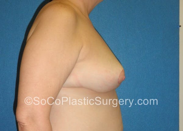 Breast Lift Before & After Gallery - Patient 5091817 - Image 6