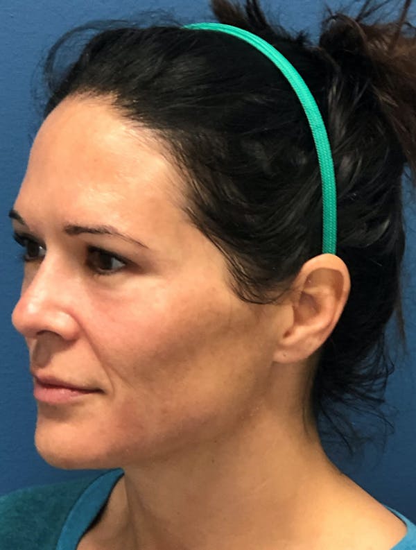 Halo Skin Resurfacing